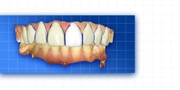 Complete prosthetic protocols CAD/CAM CEREC