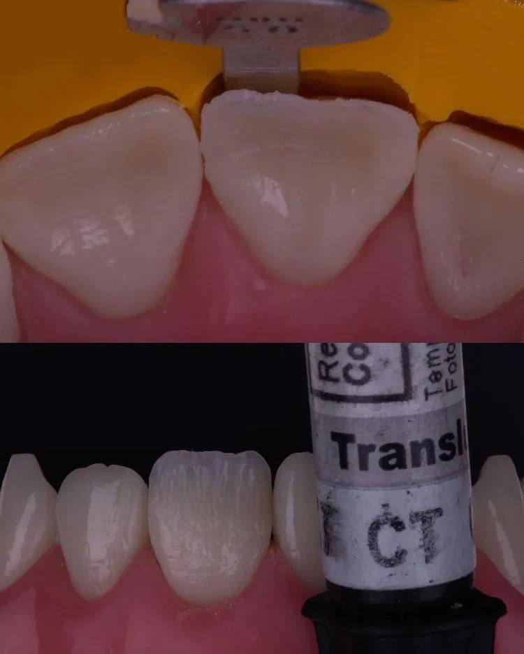 Composite Veneers, All Restorative Techniques