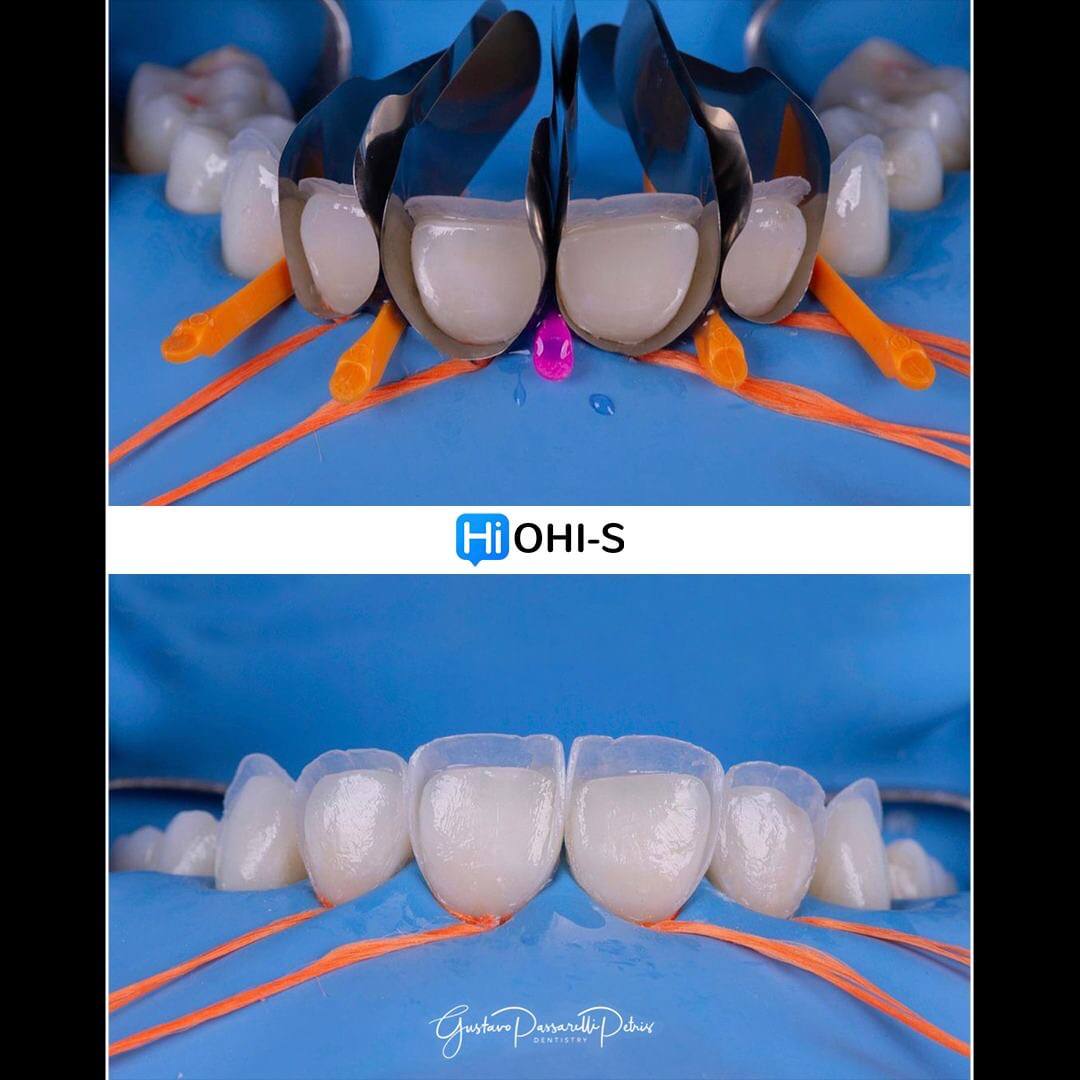 Composite Veneers, All Restorative Techniques