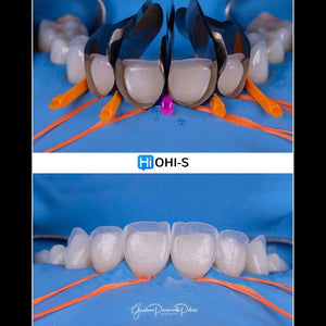 Composite Veneers, All Restorative Techniques