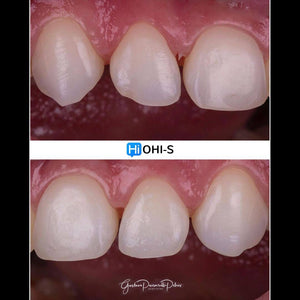 Composite Veneers, All Restorative Techniques