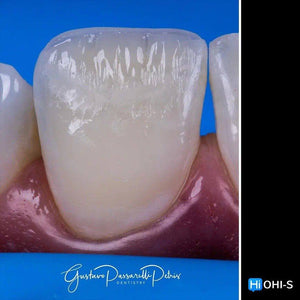 Composite Veneers, All Restorative Techniques