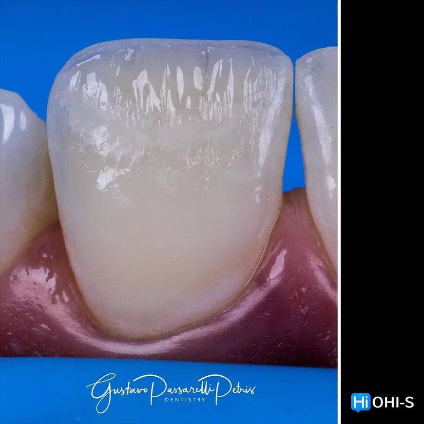 Composite Veneers, All Restorative Techniques