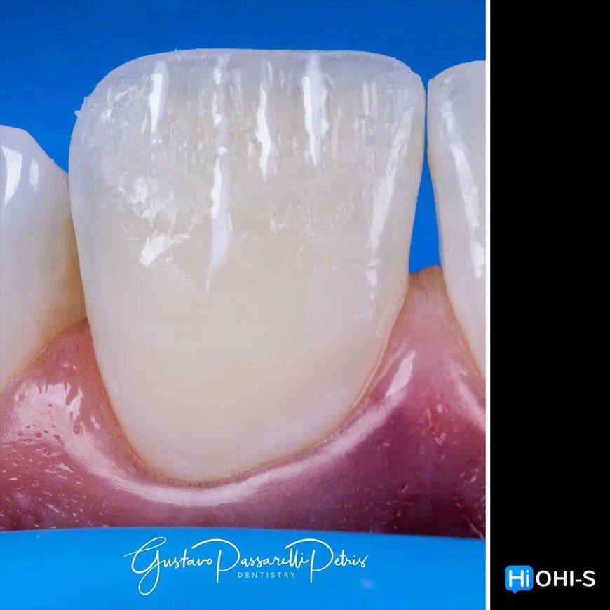 Composite Veneers, All Restorative Techniques