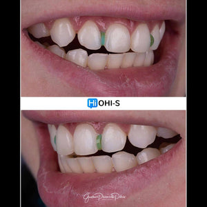 Composite Veneers, All Restorative Techniques