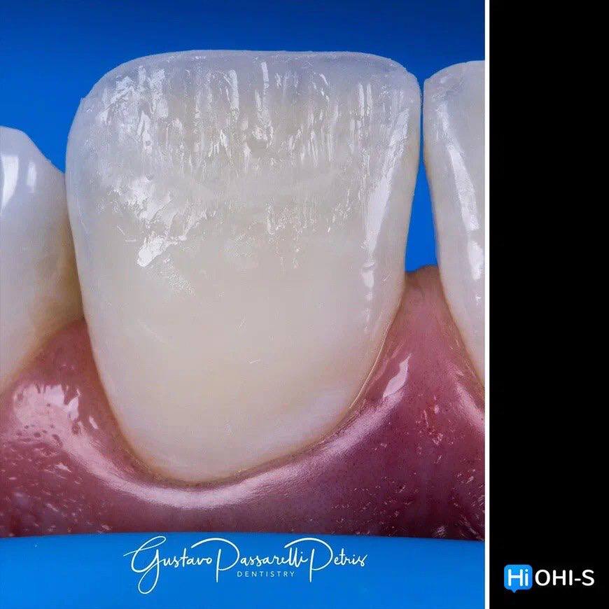Composite Veneers, All Restorative Techniques