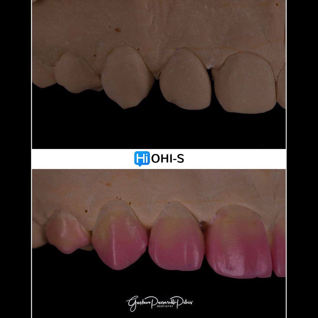 Composite Veneers, All Restorative Techniques