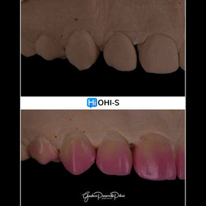 Composite Veneers, All Restorative Techniques