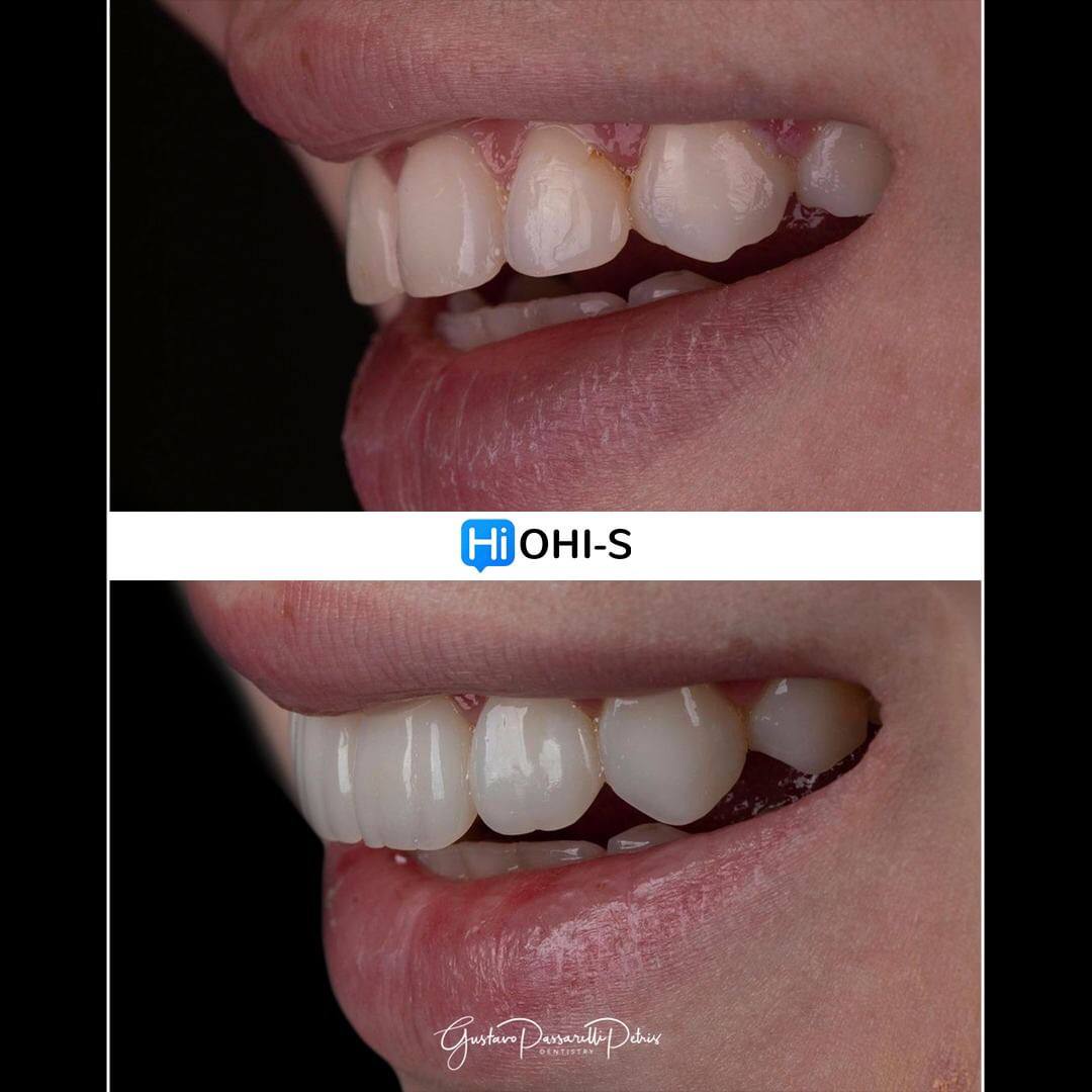 Composite Veneers, All Restorative Techniques