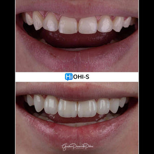 Composite Veneers, All Restorative Techniques