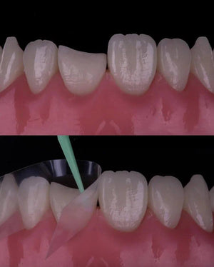 Composite Veneers, All Restorative Techniques