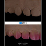 Composite Veneers, All Restorative Techniques