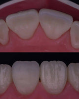 Composite Veneers, All Restorative Techniques