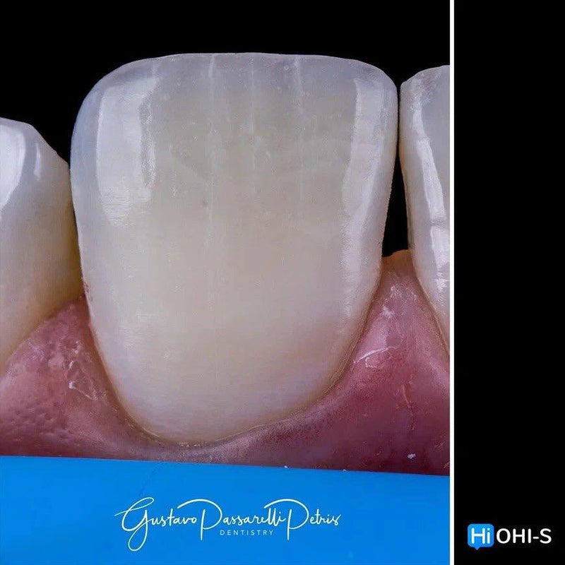 Composite Veneers, All Restorative Techniques