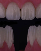 Composite Veneers, All Restorative Techniques