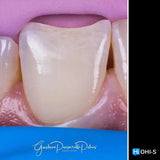 Composite Veneers, All Restorative Techniques