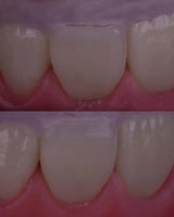 Composite Veneers, All Restorative Techniques