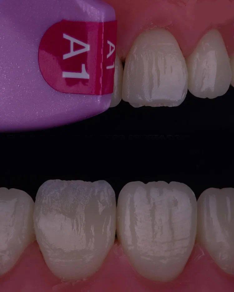 Composite Veneers, All Restorative Techniques