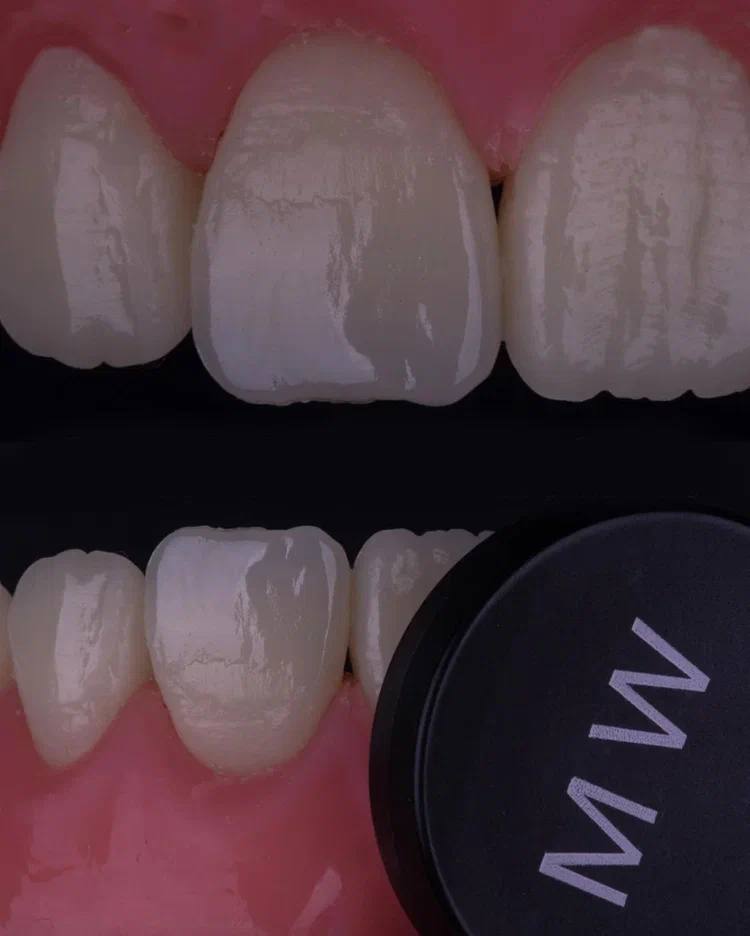 Composite Veneers, All Restorative Techniques
