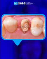The Biomimetic Concept: Composite Restoration Protocols
