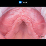 Bone Augmentation: Current Techniques