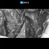 Bone Augmentation: Current Techniques