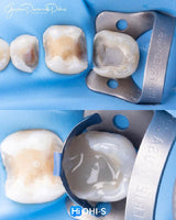 The Biomimetic Concept: Composite Restoration Protocols