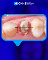 The Biomimetic Concept: Composite Restoration Protocols