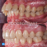 Aligners and Microimplants: Combined Protocol