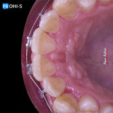 Damon 2.0. How to treat all common malocclusions