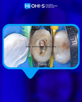 The Biomimetic Concept: Composite Restoration Protocols