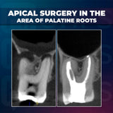 Apical Surgery: For Endodontists and Surgeons