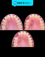 Damon 2.0. How to treat all common malocclusions