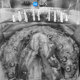 Bone Augmentation: Current Techniques