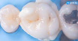 All‑Digital Workflow: Protocols for Flawless Indirect Restorations