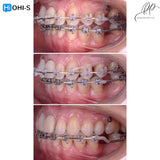 Orthodontic Preparation Before Prosthetics