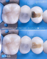 Indirect Restoration in the Biomimetic Concept
