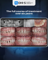 Missing Maxillary Lateral Incisors: Space Closure in All Malocclusions vs. Implants and Prosthetic Replacement