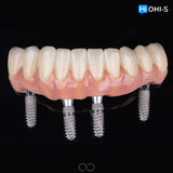 All‑Digital Workflow: Protocols for Flawless Indirect Restorations