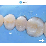 The Biomimetic Concept: Composite Restoration Protocols