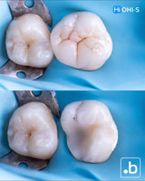 The Biomimetic Concept: Composite Restoration Protocols