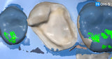 All‑Digital Workflow: Protocols for Flawless Indirect Restorations