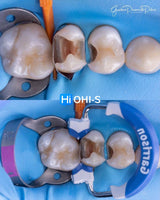 The Biomimetic Concept: Composite Restoration Protocols
