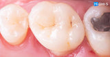 All‑Digital Workflow: Protocols for Flawless Indirect Restorations