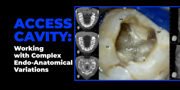 Access Cavity: Working with Complex Endodontic Anatomical Variations