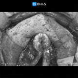 Bone Augmentation: Current Techniques