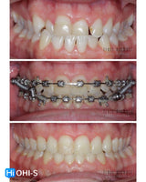 Damon 2.0. How to treat all common malocclusions