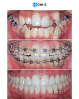 Damon 2.0. How to treat all common malocclusions
