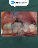 Biomechanics in Orthodontics