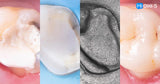 All‑Digital Workflow: Protocols for Flawless Indirect Restorations